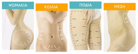 Κρυολιπόλυση σημεία εφαρμογής