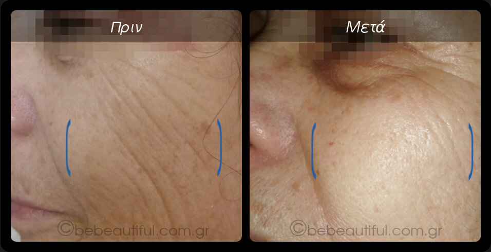 Plasma Lift, θεραπεία για ρυτίδες