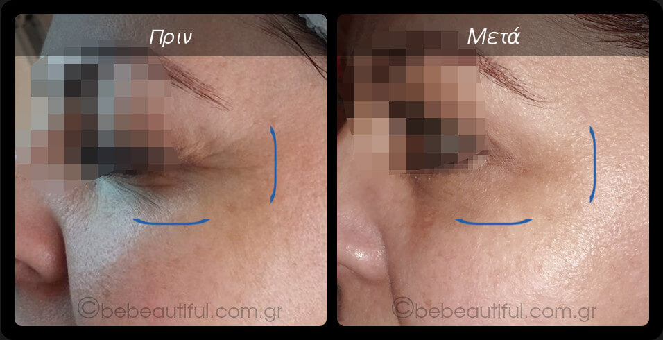 Plasma Lift, θεραπεία ρυτίδες στο πόδι της χήνας