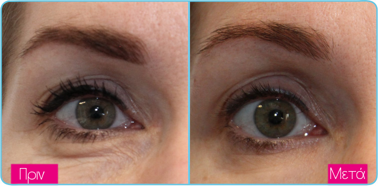 Dermatude eyes1 ba