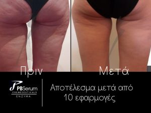 Kυτταρίτιδα | ένζυμα PBSerum - πριν & μετά