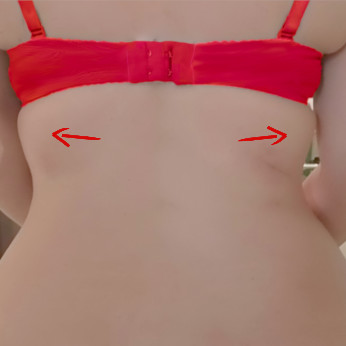 Θεραπείες - Τοπικό πάχος στην πλάτη